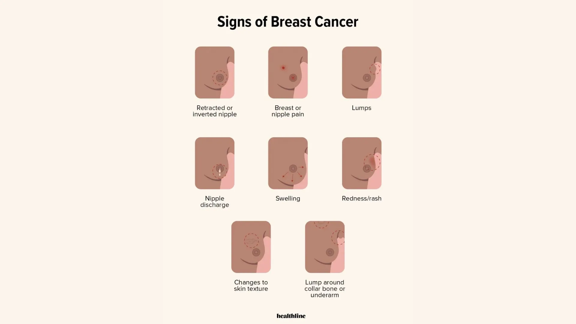 Signs of breast cancer, adapted from healthline.com